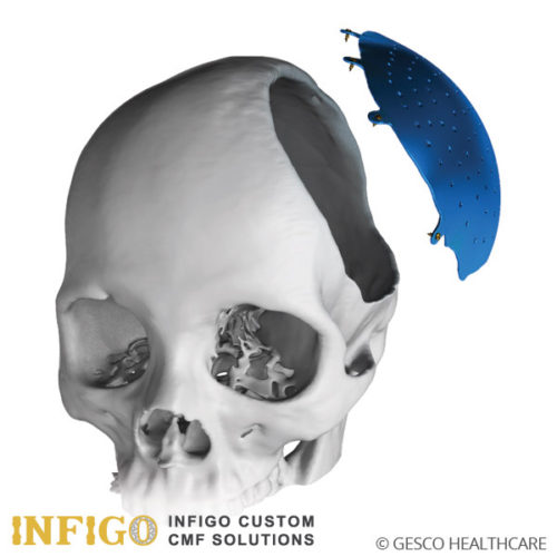 Infigo Custom Implants