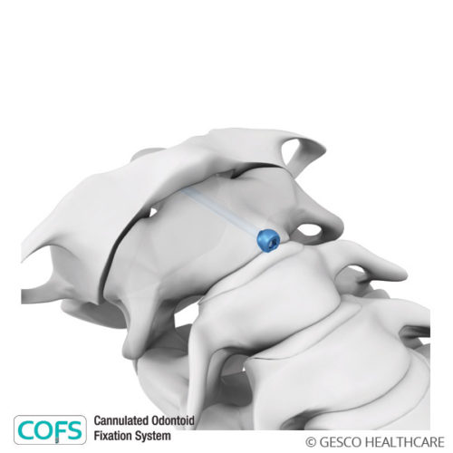 COFS – Cannulated Odontoid Fixation System